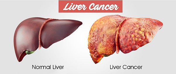 liver cancer