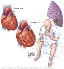 heart failure can mimic asthma