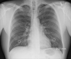 Chest radiograph is normal in allergic asthma