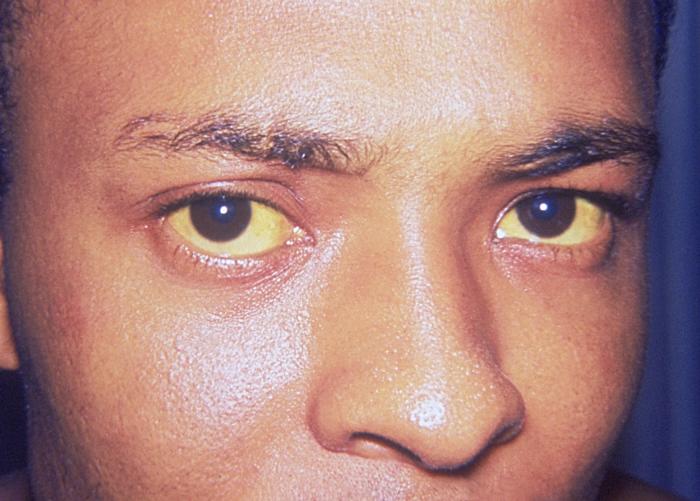 jaundice caused by hepatitis A