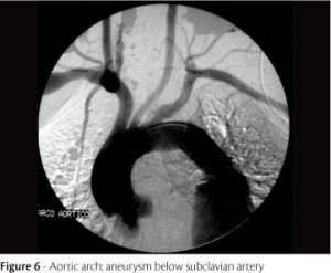 behcet's disease