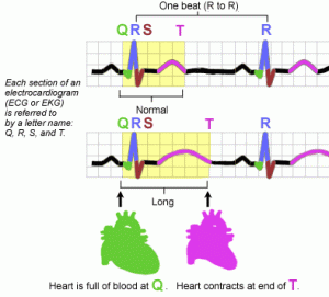 QT prolongation due to fluoroquinolones