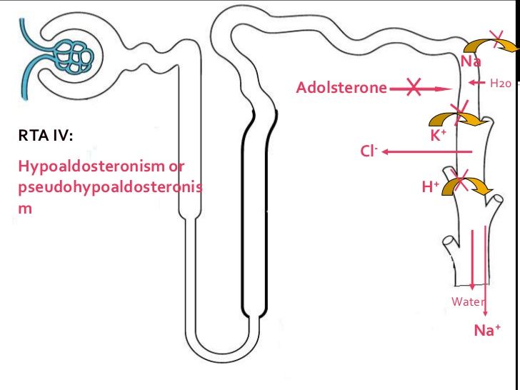  type 4 Renal Tubular Acidosis