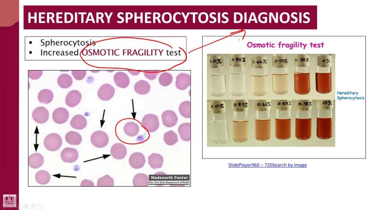 Hereditary Spherocytosis - Inheritance, Symptoms And Treatment - Fever.pk