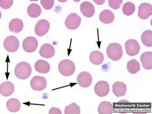 hereditary spherocytosis