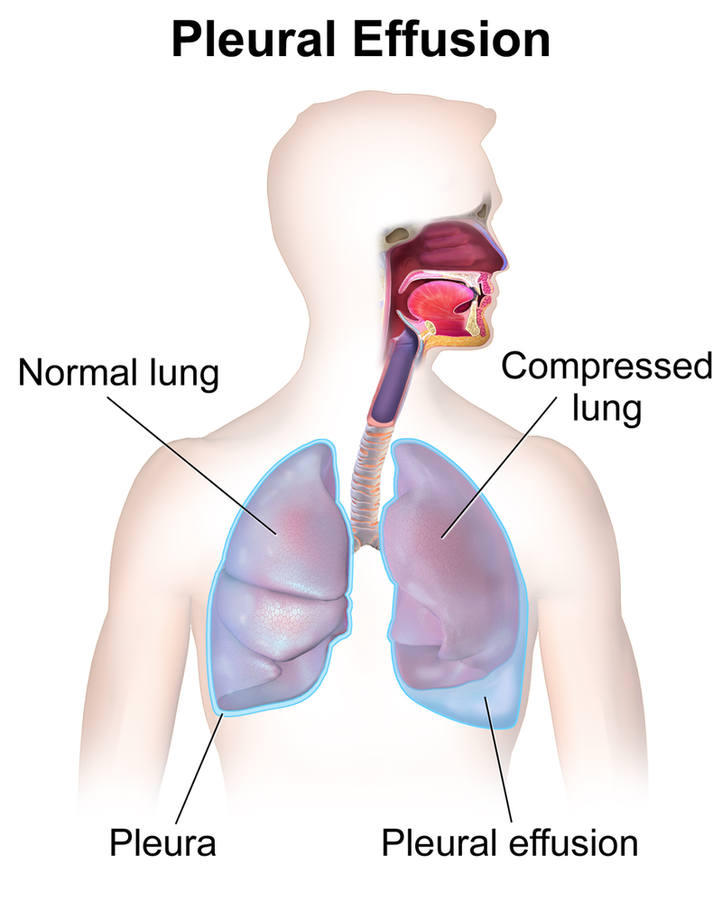 pleural effusion