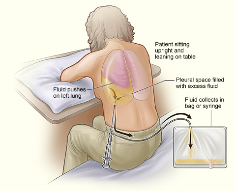 pleural effusion drainage